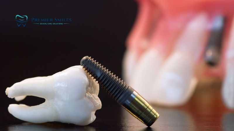 All About Dental Implant
