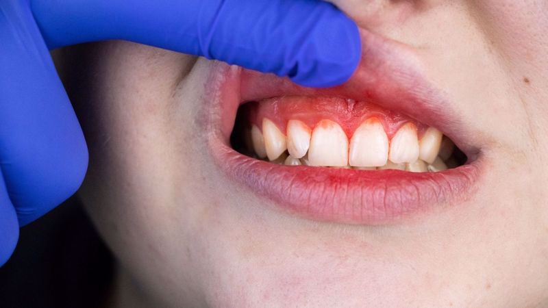 Causes and treatments for periodontal disease
