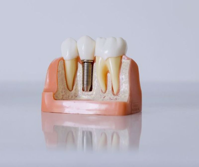 Dental Implants: A Guide to Care and Longevity