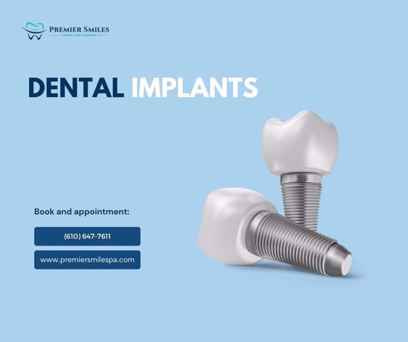 Should you consider getting Dental Implants?