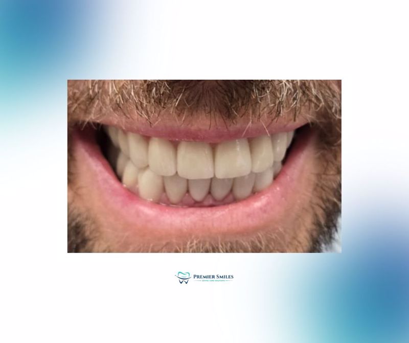 Smile Reimagined: A Life-Changing Transformation with Custom Dental Crowns at Premier Smiles