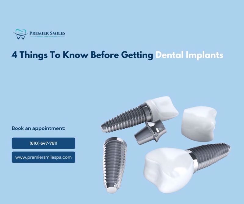 4 Things To Know Before Getting Dental Implants