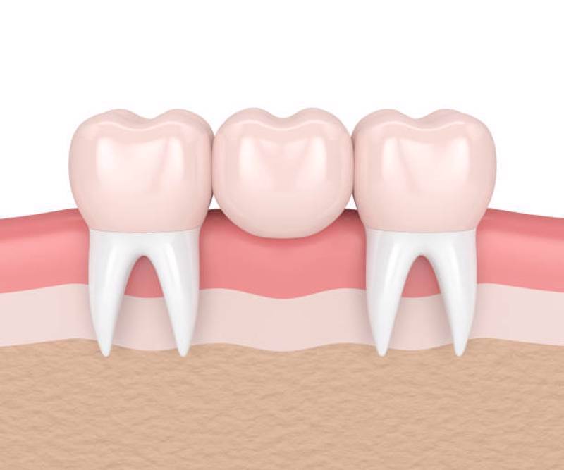 What you need to know about dental bridges