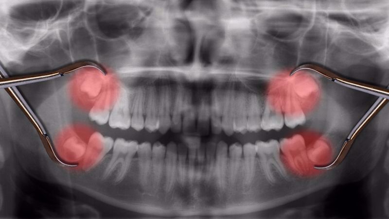 Wisdom teeth removal. Is it necessary?