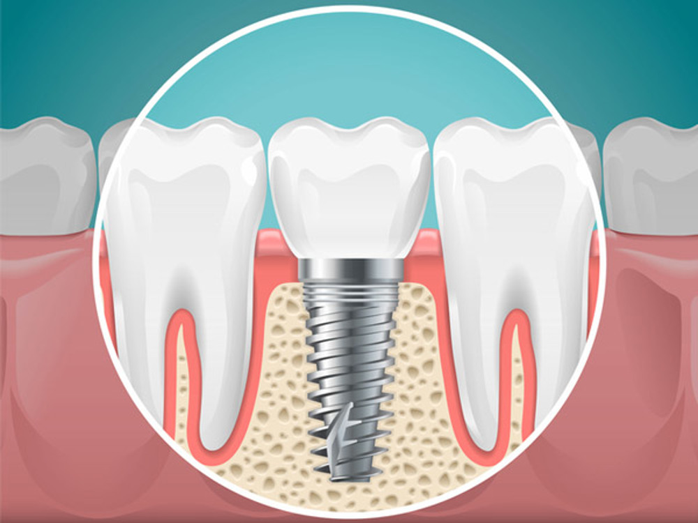 What are the advantages and disadvantages of dental implants?
