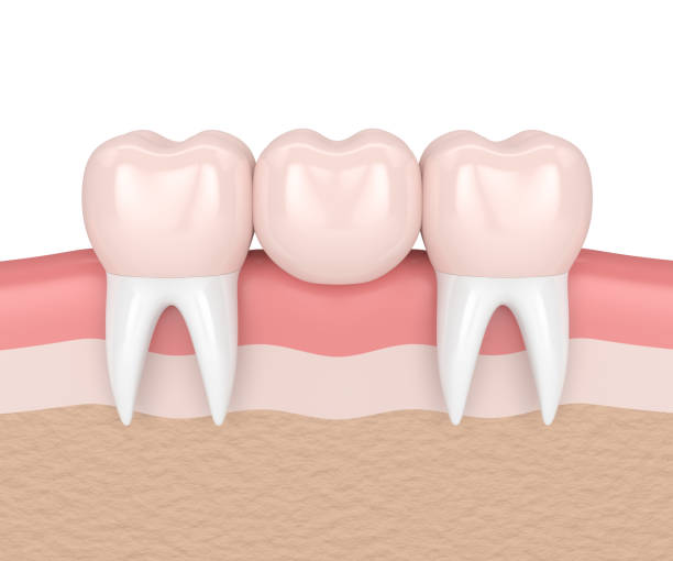 dental bridges in Berwin 