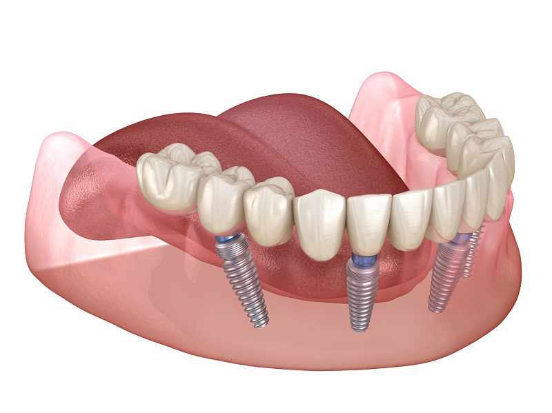 All on 4 Dental Implants