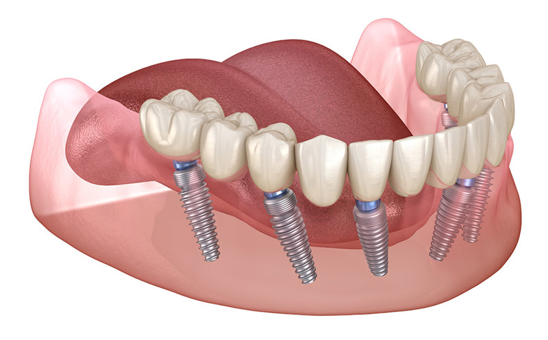 All on 6 Dental Implants