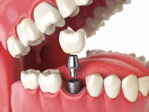 Dental implants