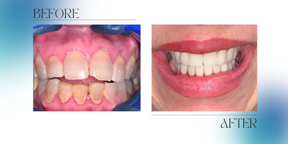 Transforming a patient’s Smile with Dental crowns at Premier Smiles