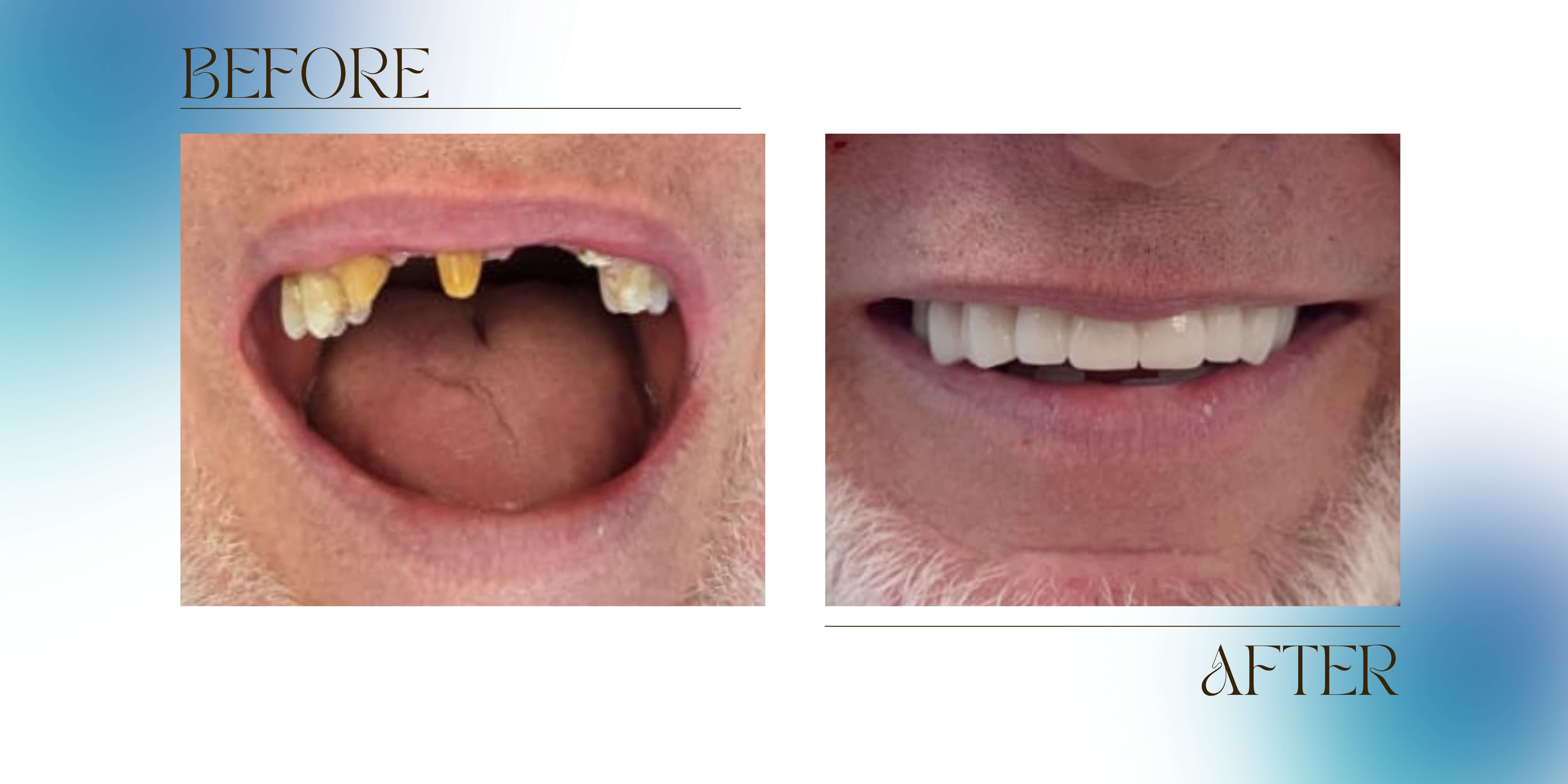 A Same-Day Smile Transformation with Zirconia Crowns at Premier Smiles