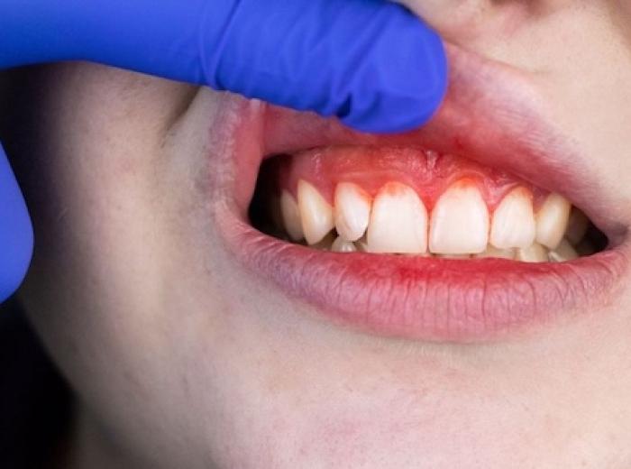 Causes and treatments for periodontal disease