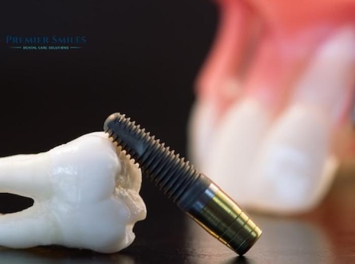 All About Dental Implant
