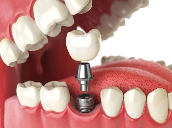 What to Eat After Dental Implant Surgery: A Guide to Aid Your Recovery
