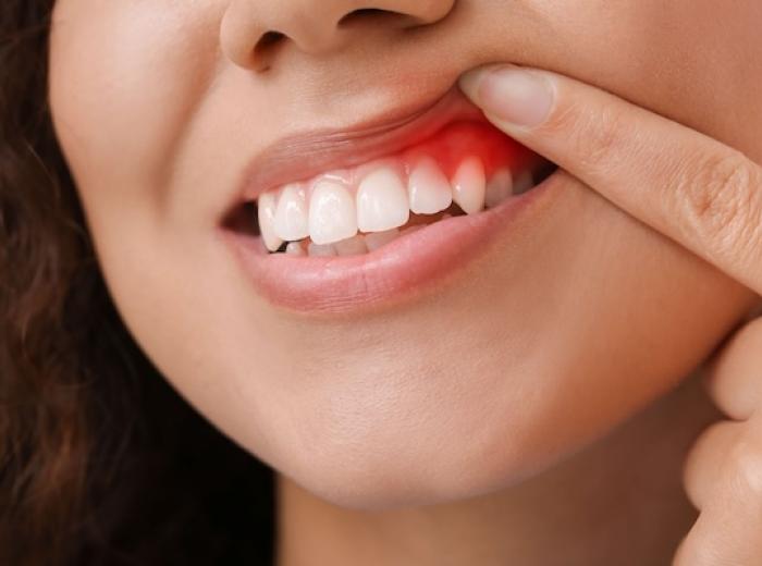 Diagnosed with gingivitis? Here are some home remedies