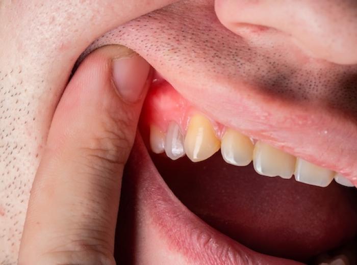 How to keep your gums healthy