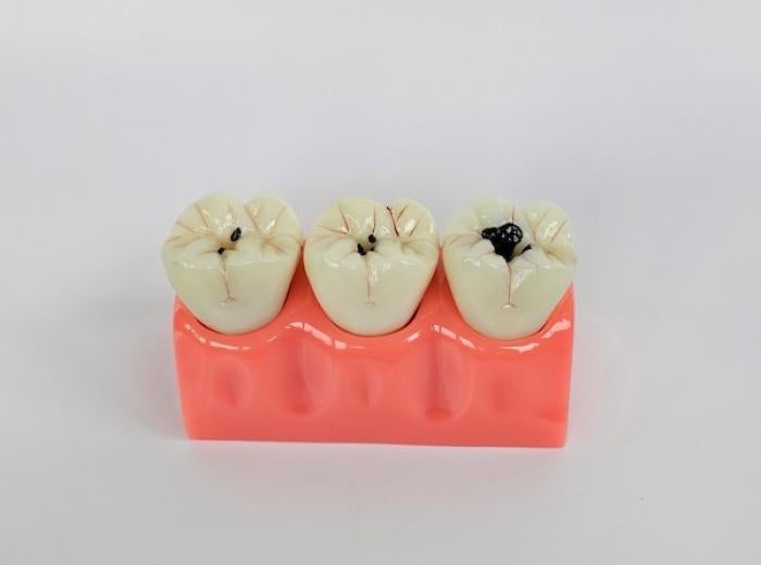 Tooth decay: Causes, prevention and treatment