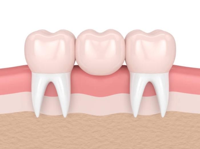 What you need to know about dental bridges