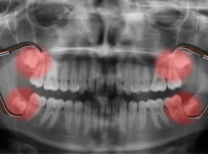 Wisdom teeth removal. Is it necessary?