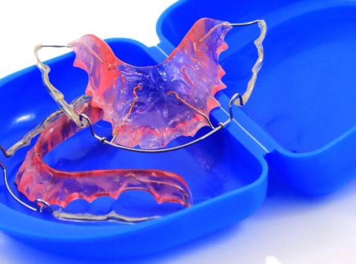 5 Signs It’s Time to Replace Your Retainer