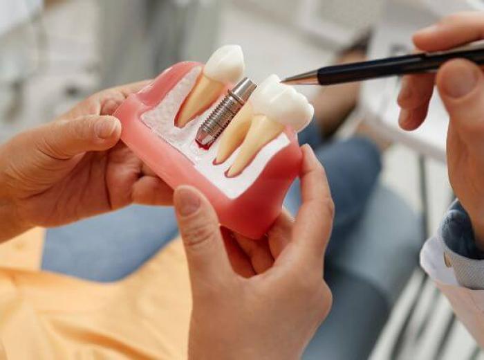 Dentures vs. Implants: Exploring Options for Full Arch Restoration