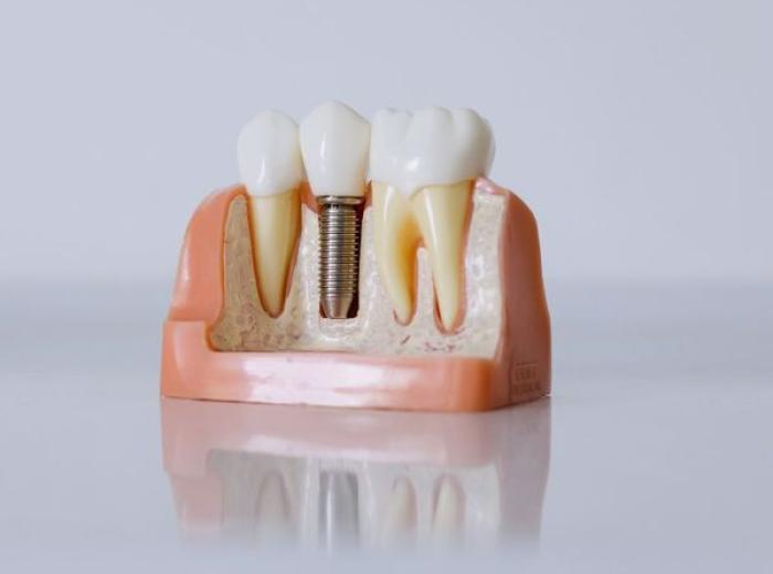 Dental Implants: A Guide to Care and Longevity