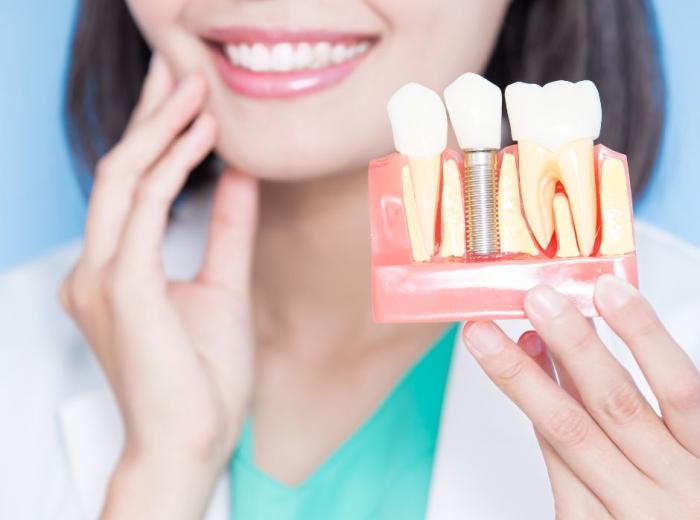 Full Mouth Reconstructions with Dental Implants