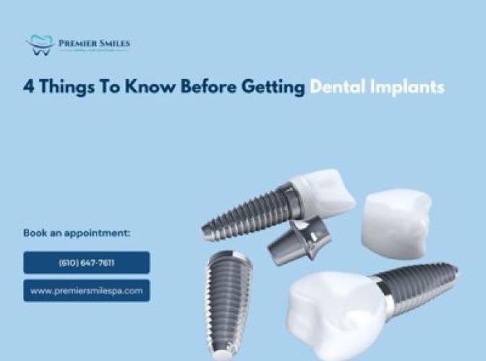 4 Things To Know Before Getting Dental Implants