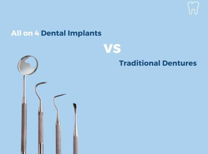 All on 4 Dental Implants vs Traditional Dentures