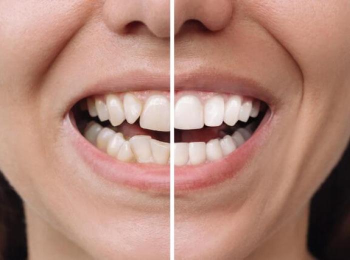 The Benefits of Cosmetic Dentistry: Procedures, Options, and Smile Enhancement
