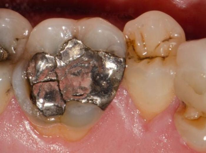 5 Reasons Most Dentists Have Stopped Using Mercury in Dental Procedures