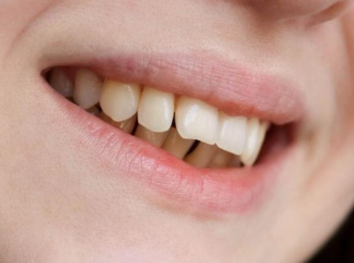 Signs You Need a Bite Adjustment and How Your Dentist Can Help