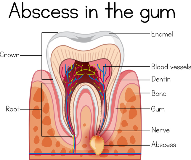 Can You Fly With a Tooth Infection? What Berwyn Patients Need to Know